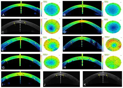 Corneal Stromal Regeneration: A Review of Human Clinical Studies in Keratoconus Treatment